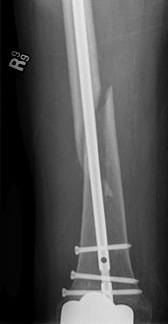 TKR Femoral Nail AP